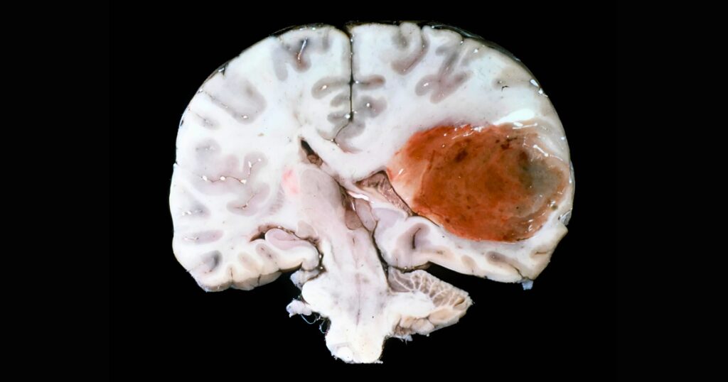 electro-oncologia quimioterapia radioterapia inmunoterapia tratamiento cancer oncologia glioblastoma tumor cerebral