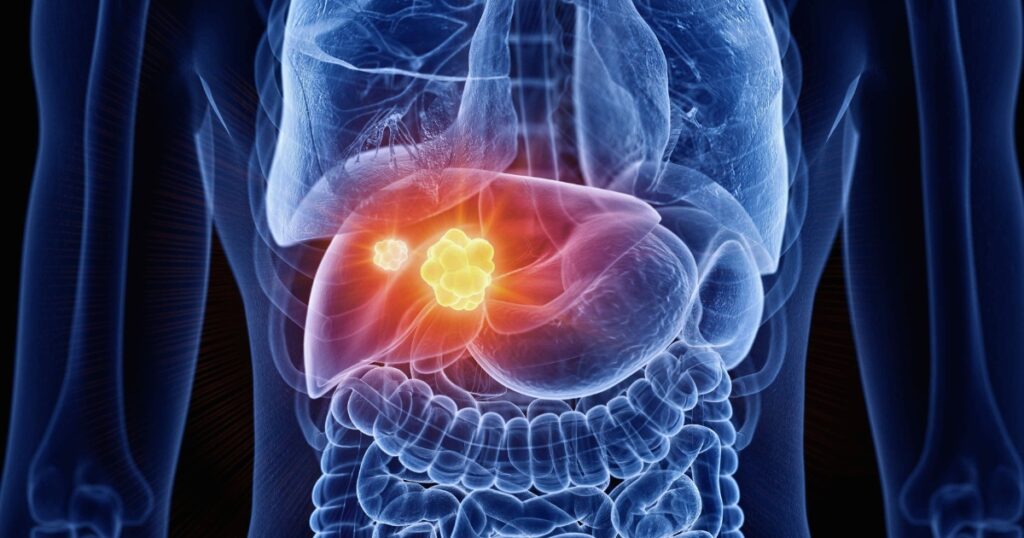 electro-oncologia quimioterapia radioterapia tratamiento cancer oncologia higado carcinoma hepatocelular