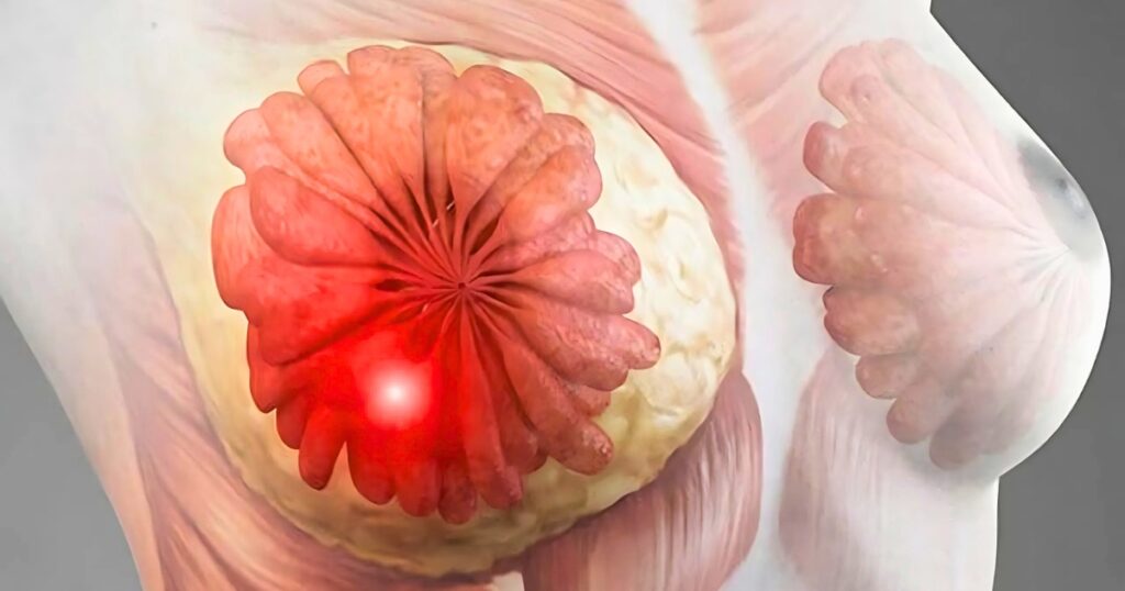 electro-oncologia quimioterapia radioterapia tratamiento cancer oncologia mama seno