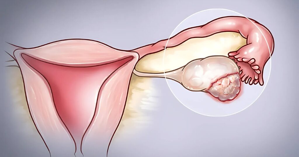 electro-oncologia quimioterapia radioterapia tratamiento cancer oncologia ovario