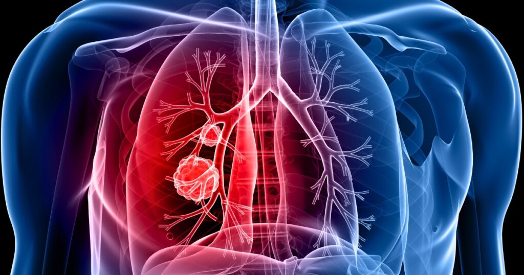 electro-oncologia-quimioterapia-radioterapia-tratamiento-cancer-pulmon