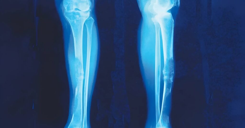 electro-oncologia quimioterapia radioterapia tratamiento cancer sarcoma